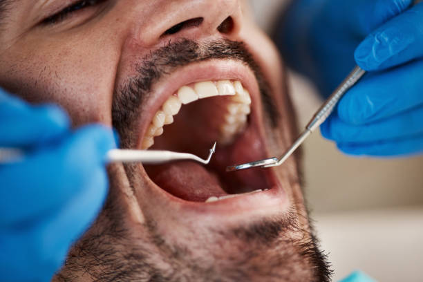 Best Teeth Whitening  in Clinton, WA